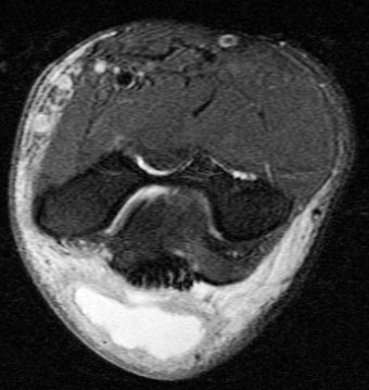 Figure 3 for case olecranon bursitis ( RID2082 )